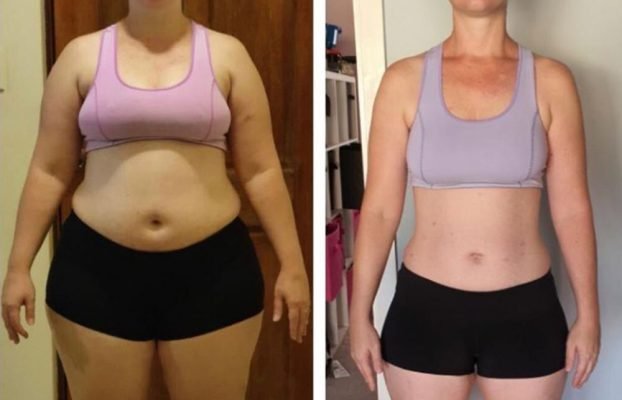 Was erwartet mich 1 Jahr nach der Operation der Magenhülse?