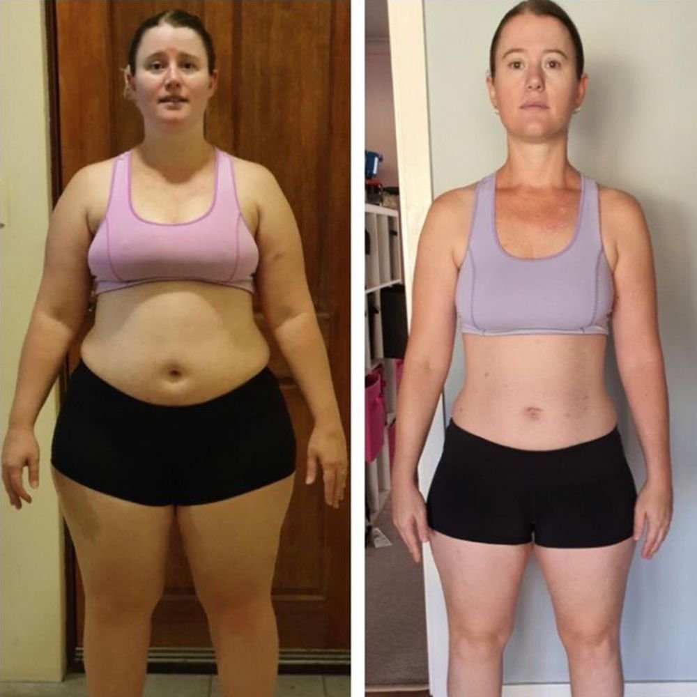 What to Expect 1 Year After Gastric Sleeve Surgery?