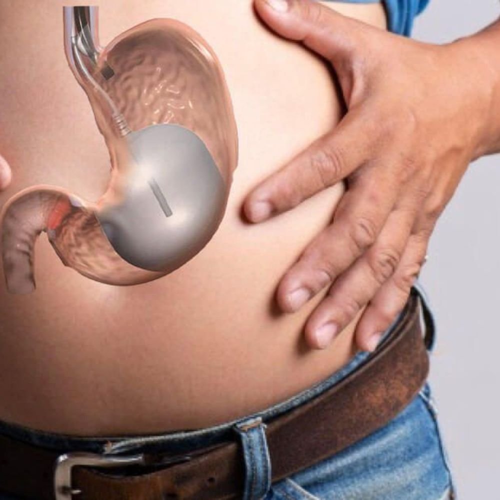 Gastric Balloon