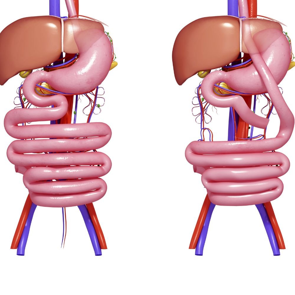 Discover the Benefits of Gastric Bypass Surgery in Turkey