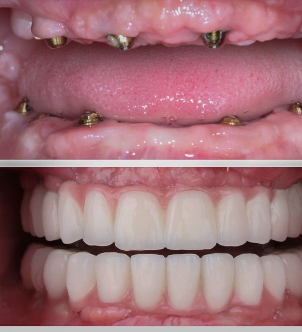 Full Mouth Dental Implants 