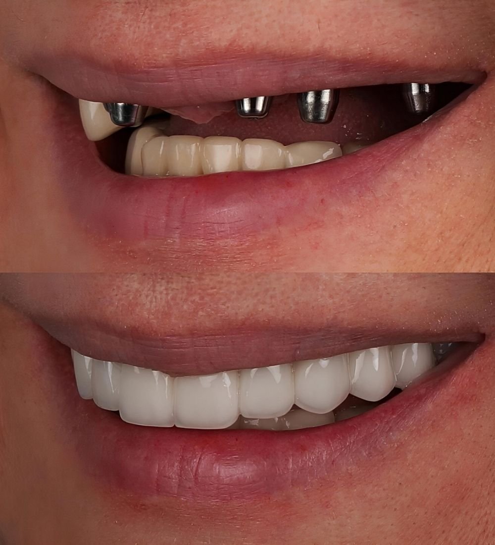 All on 4 Dental Implants