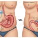 Gastric Sleeve vs. Gastric Balloon