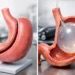 Gastric Sleeve Versus Balloon: Which Fits?